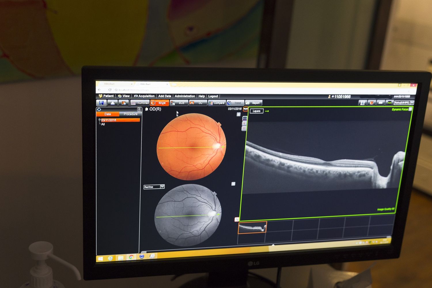 &nbsp;Scansione di una retina