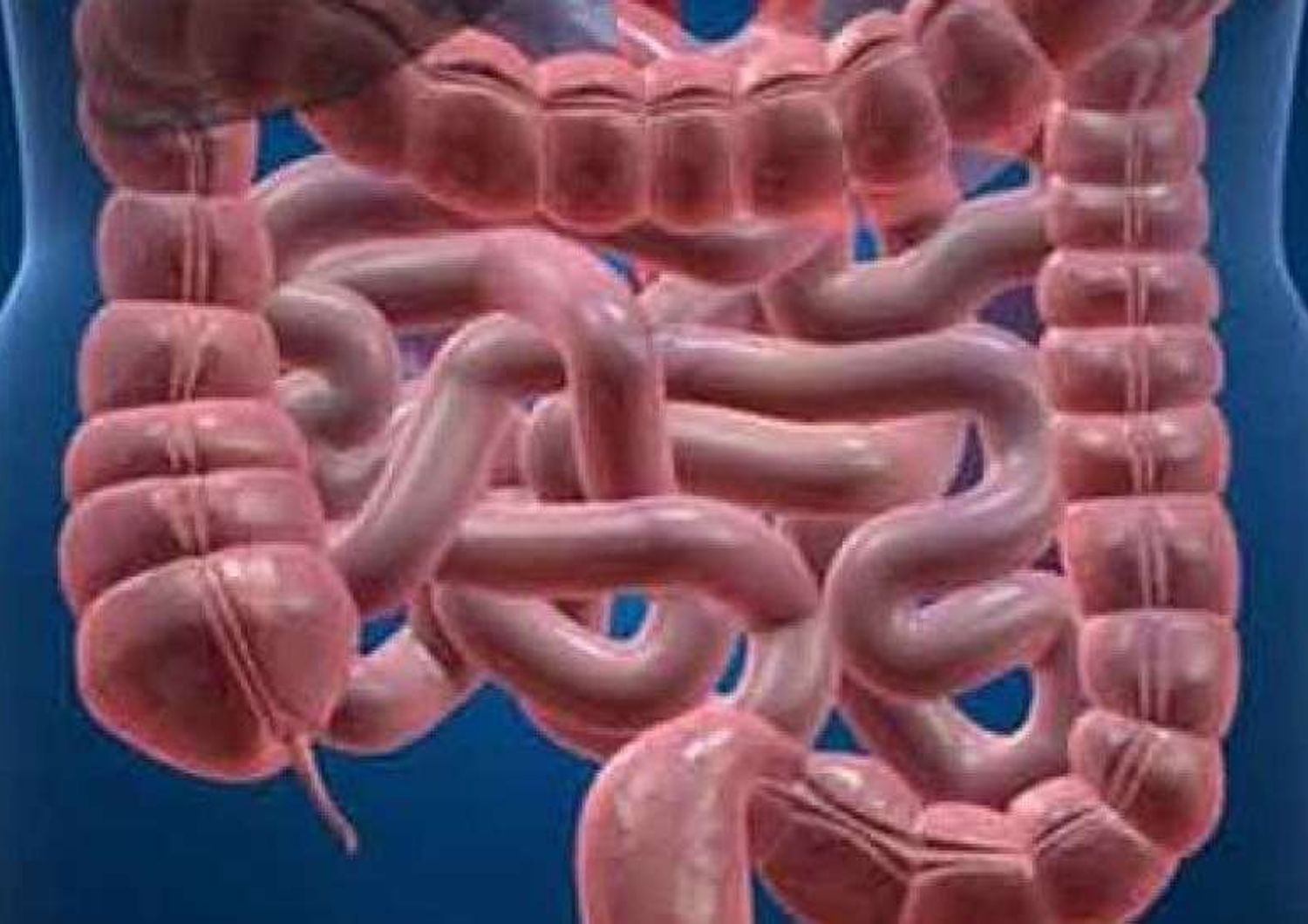 Batteri intestinali trasformano carboidrati in cancro colon-retto