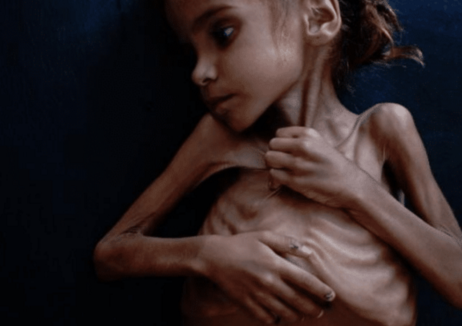 &Egrave; morta a 7 anni per fame la bambina yemenita diventata un &#39;simbolo&#39; del New York Times