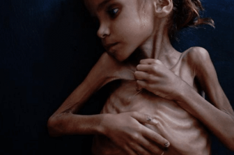 &Egrave; morta a 7 anni per fame la bambina yemenita diventata un &#39;simbolo&#39; del New York Times