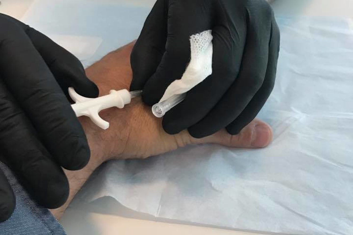 &nbsp;L'installazione di un chip sottopelle