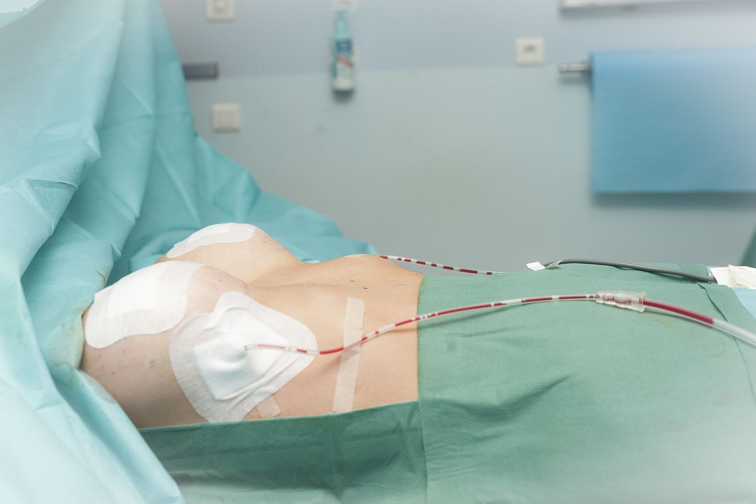 &nbsp;Un'operazione di impianto di protesi mammarie