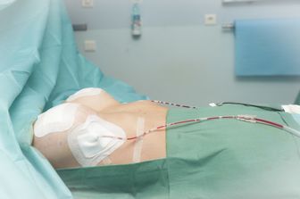 &nbsp;Un'operazione di impianto di protesi mammarie