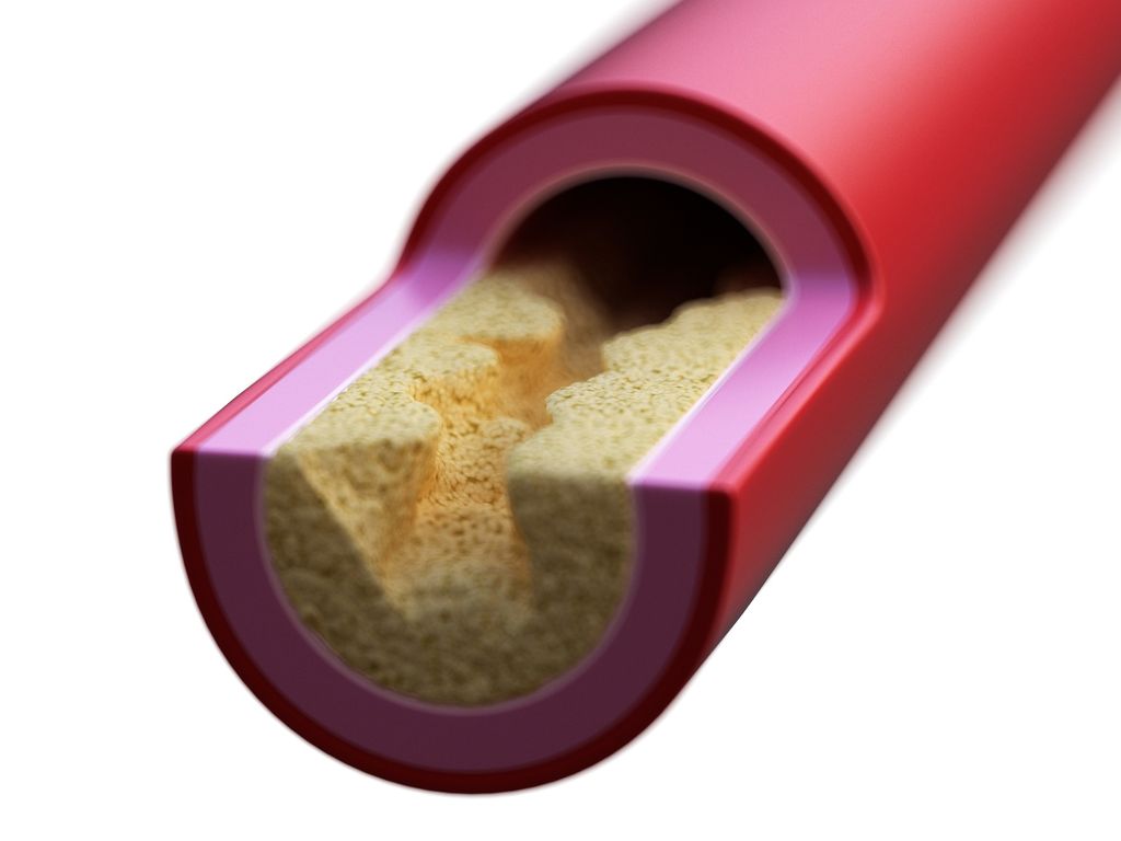 Colesterolo in arteria