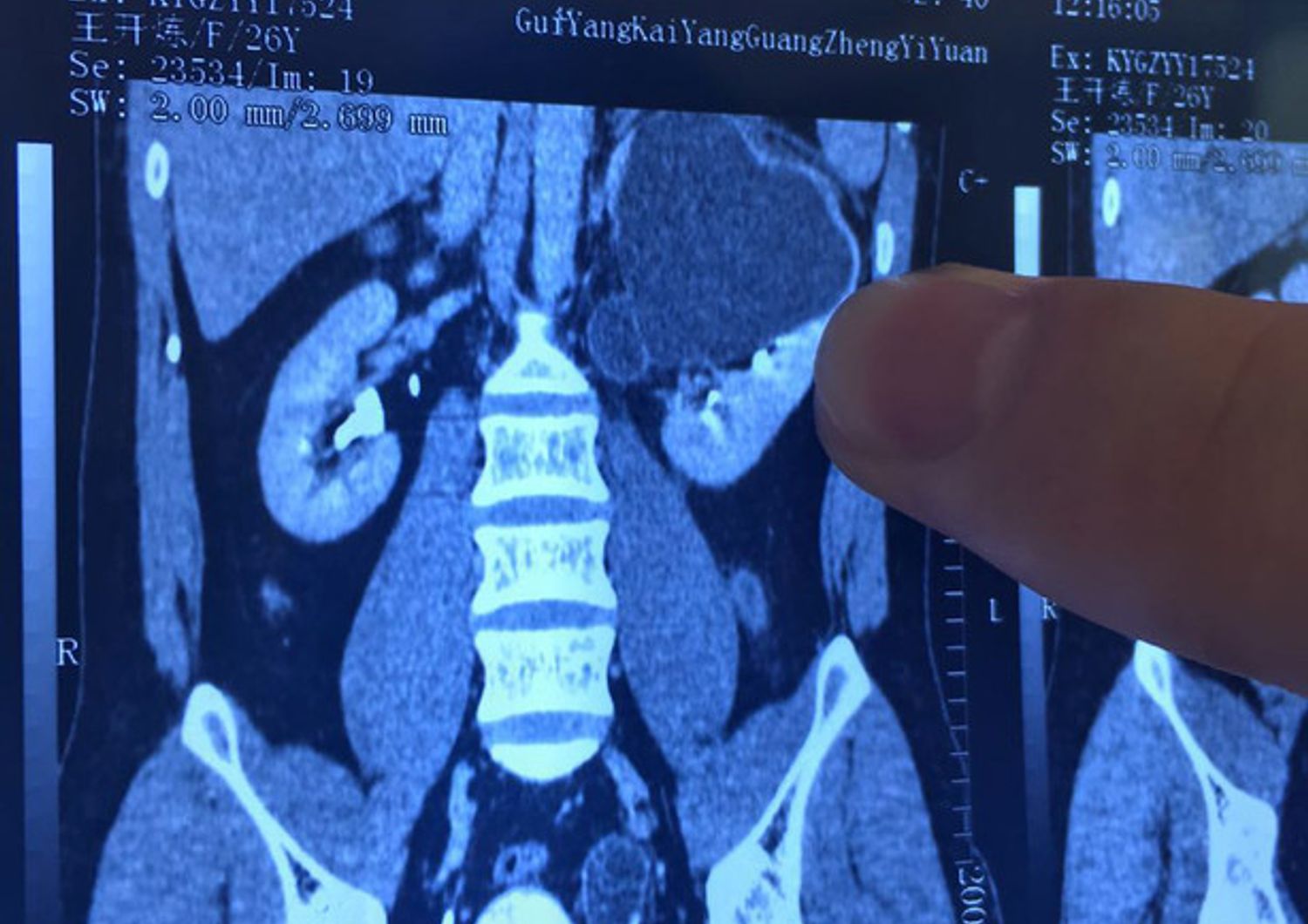 La radiografia di un rene