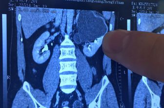 La radiografia di un rene