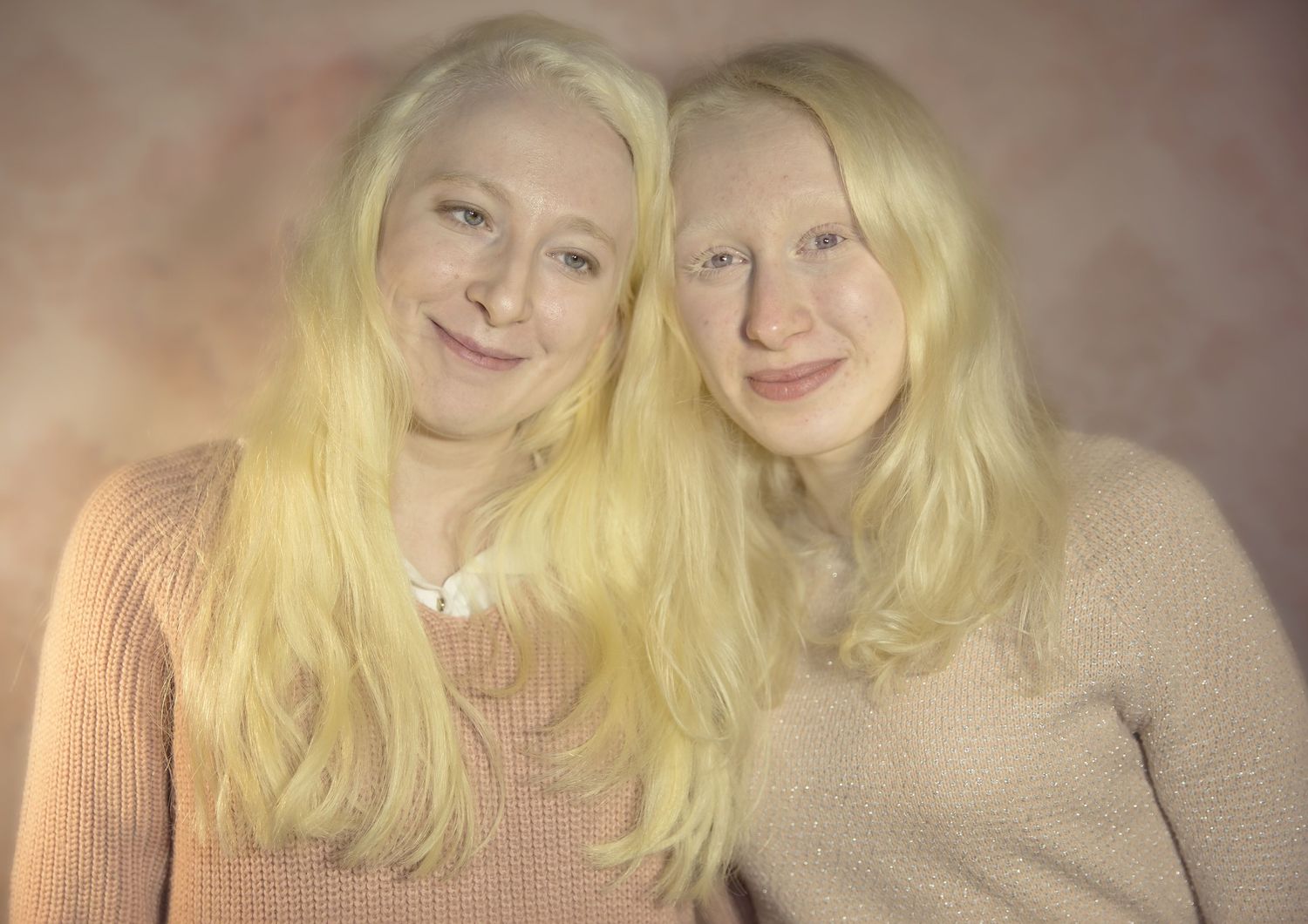 albini albinismo giornata mondiale
