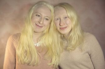 albini albinismo giornata mondiale