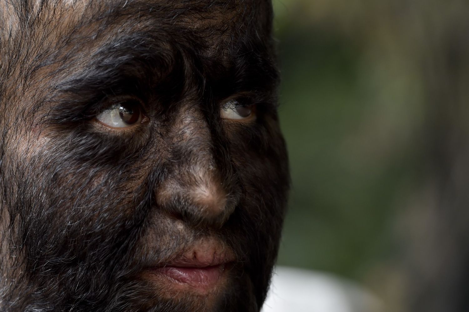 Una persona che soffre della &quot;sindrome del lupo mannaro&quot;