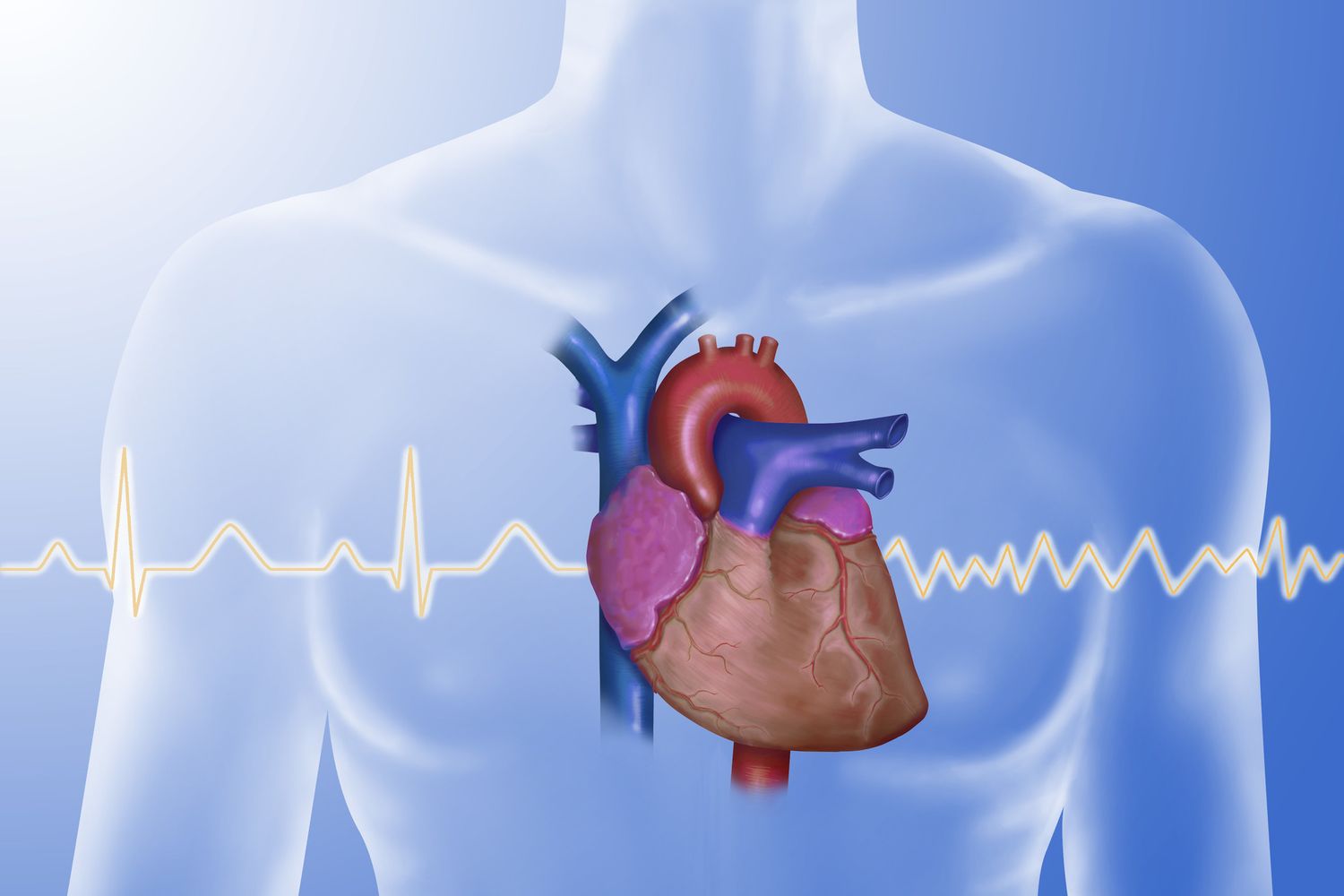 Aritmia ventricolare