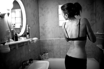 Una donna affetta da anoressia