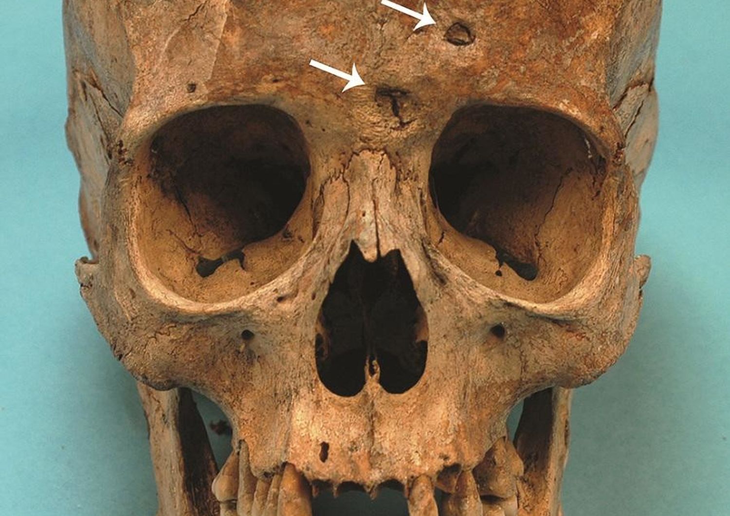 Il cranio di Maria Salvati con le lesioni sifilitiche sull'osso frontale