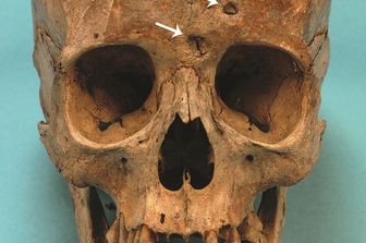 Il cranio di Maria Salvati con le lesioni sifilitiche sull'osso frontale