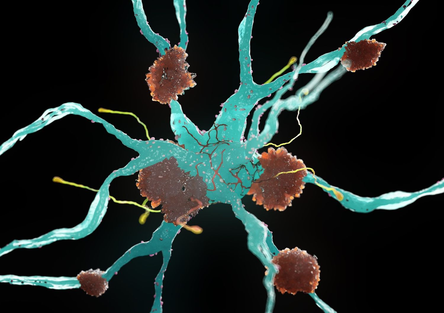 Cellule nervose del morbo di Alzheimer