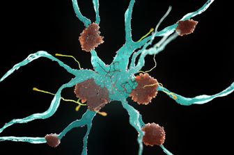 Cellule nervose del morbo di Alzheimer