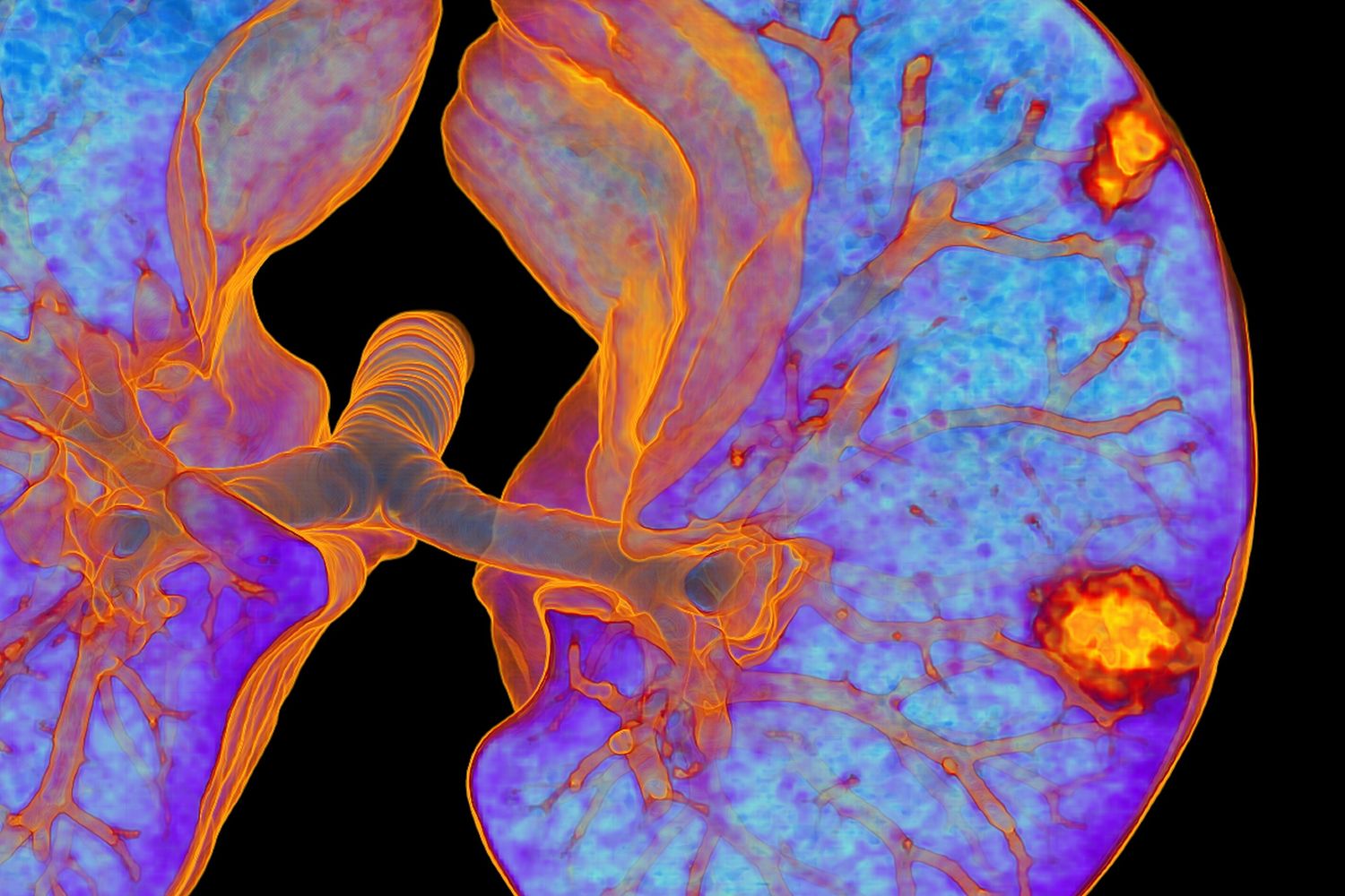 Ricostruzione polmoni in 3D