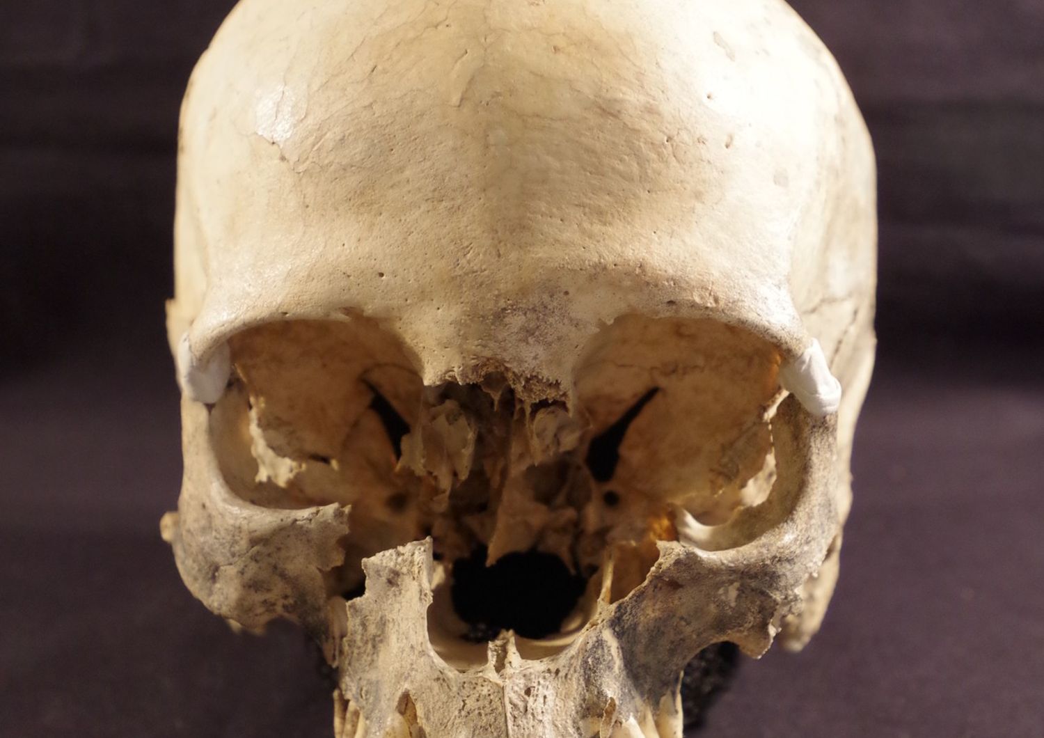 Il cranio della donna di 5.000 anni fa ritrovato vicino a Bologna