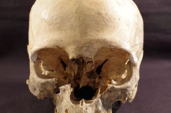 Il cranio della donna di 5.000 anni fa ritrovato vicino a Bologna