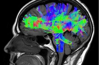 Immagine del cranio con taglio sagittale dell'encefalo