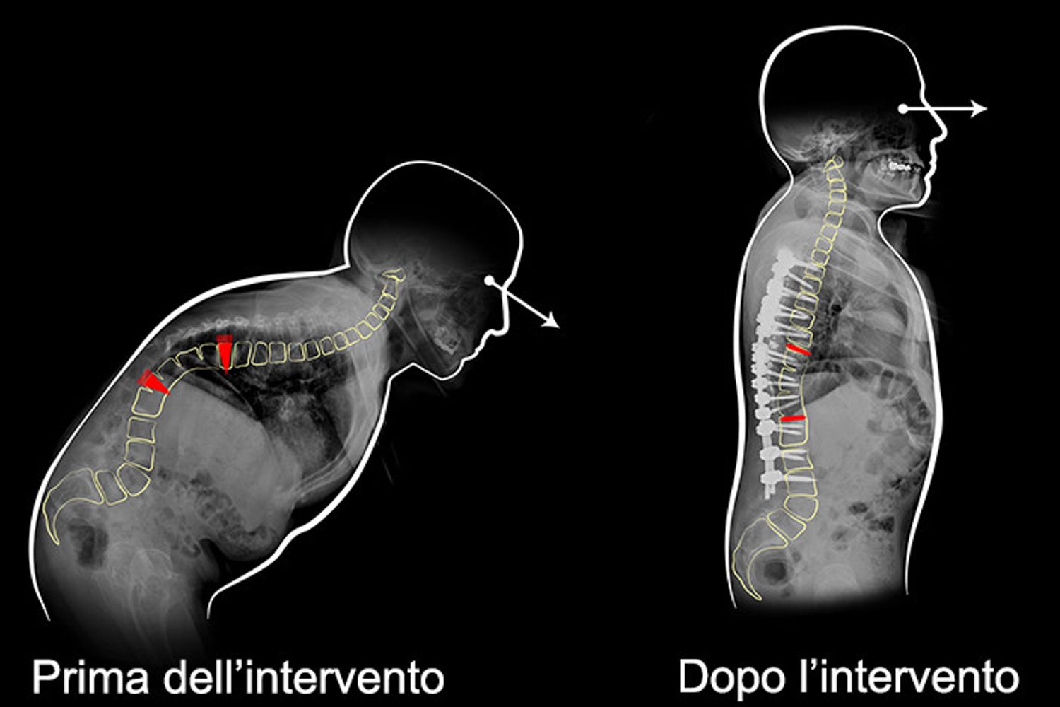 L'intervento alla colonna vertebrale