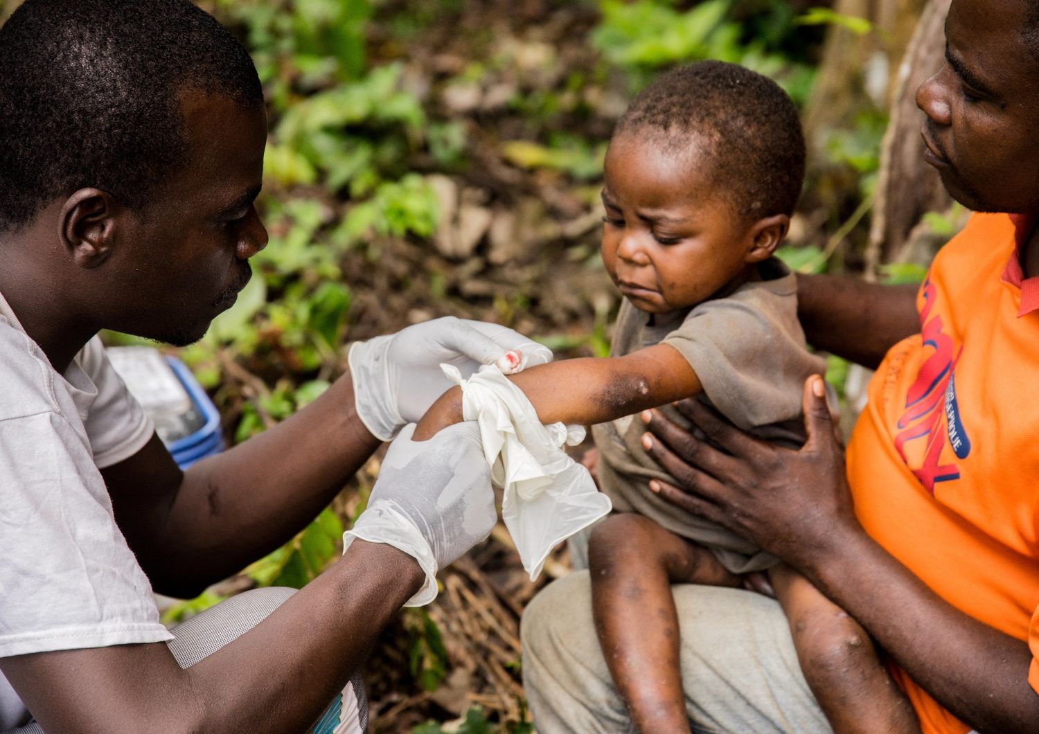 Centrafrica: un bambino malato di vaiolo delle scimmie