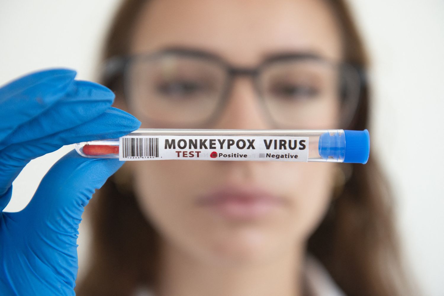 Vaiolo delle scimmie&nbsp;