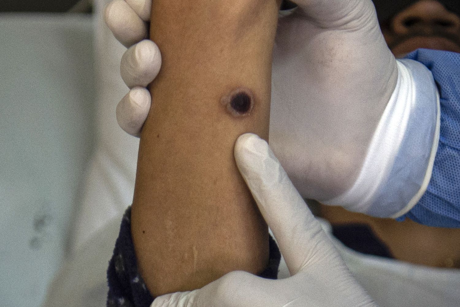 Reazione causata dal vaiolo delle scimmie