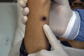 Reazione causata dal vaiolo delle scimmie