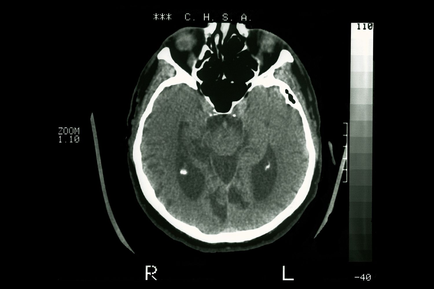 Una tac del cervello evidenzia i segni di&nbsp;Alzheimer