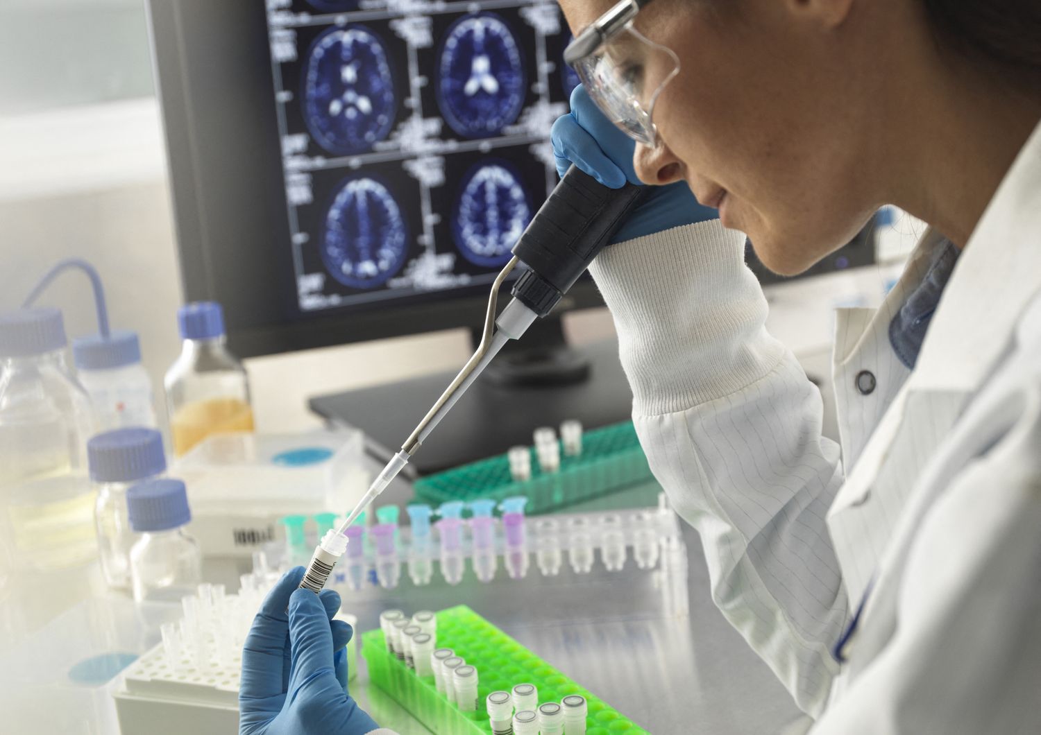 salute rischio riduzione cervello con farmaci contro alzheimer