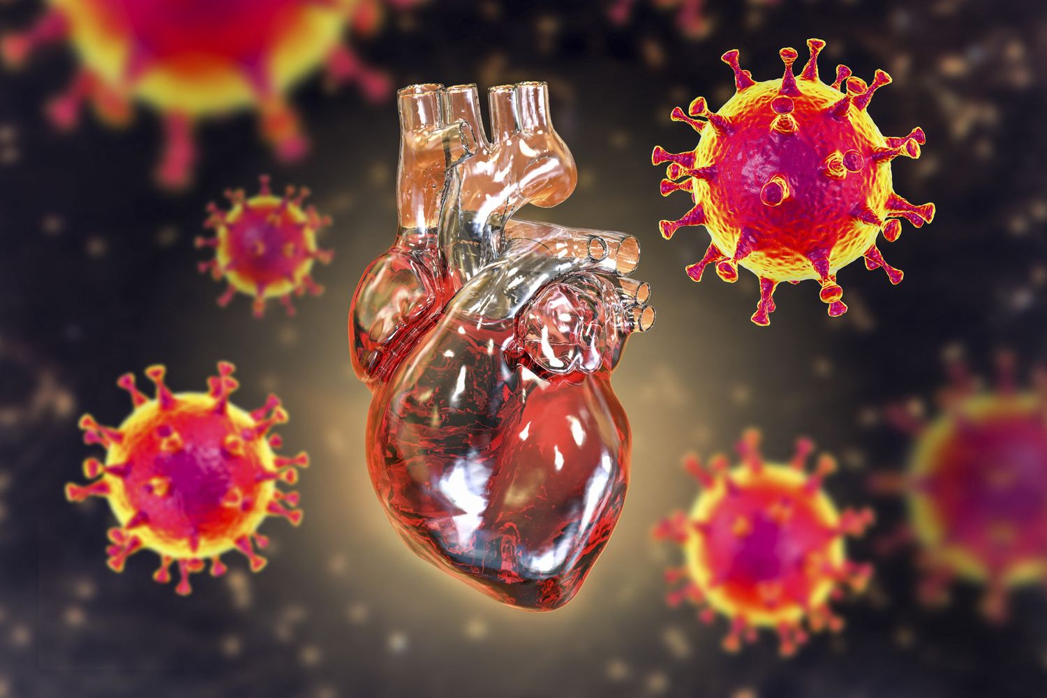 Miocardite - Covid 19