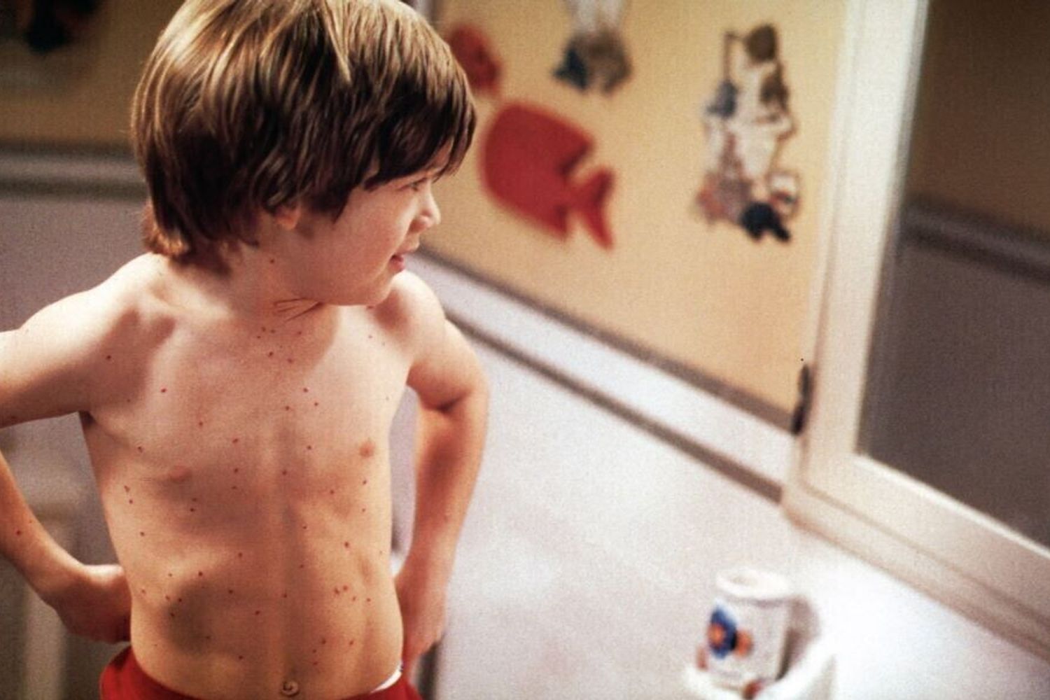 Un bambino malato di morbillo