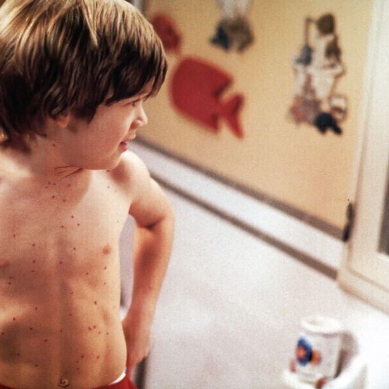 Un bambino malato di morbillo