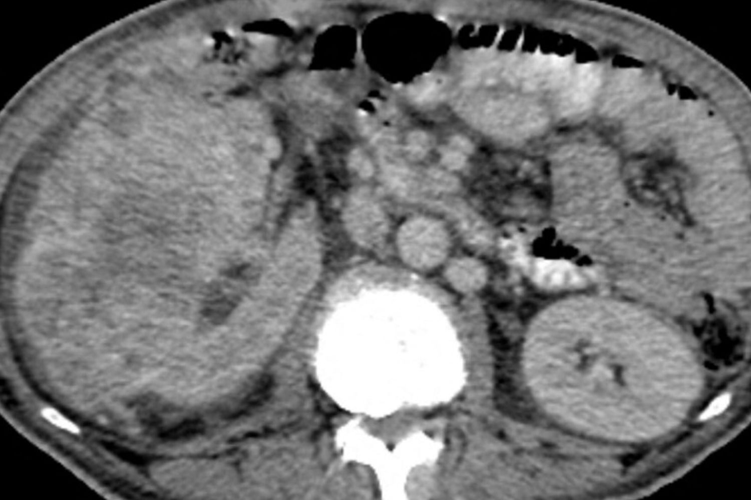 Carcinoma renale, TAC