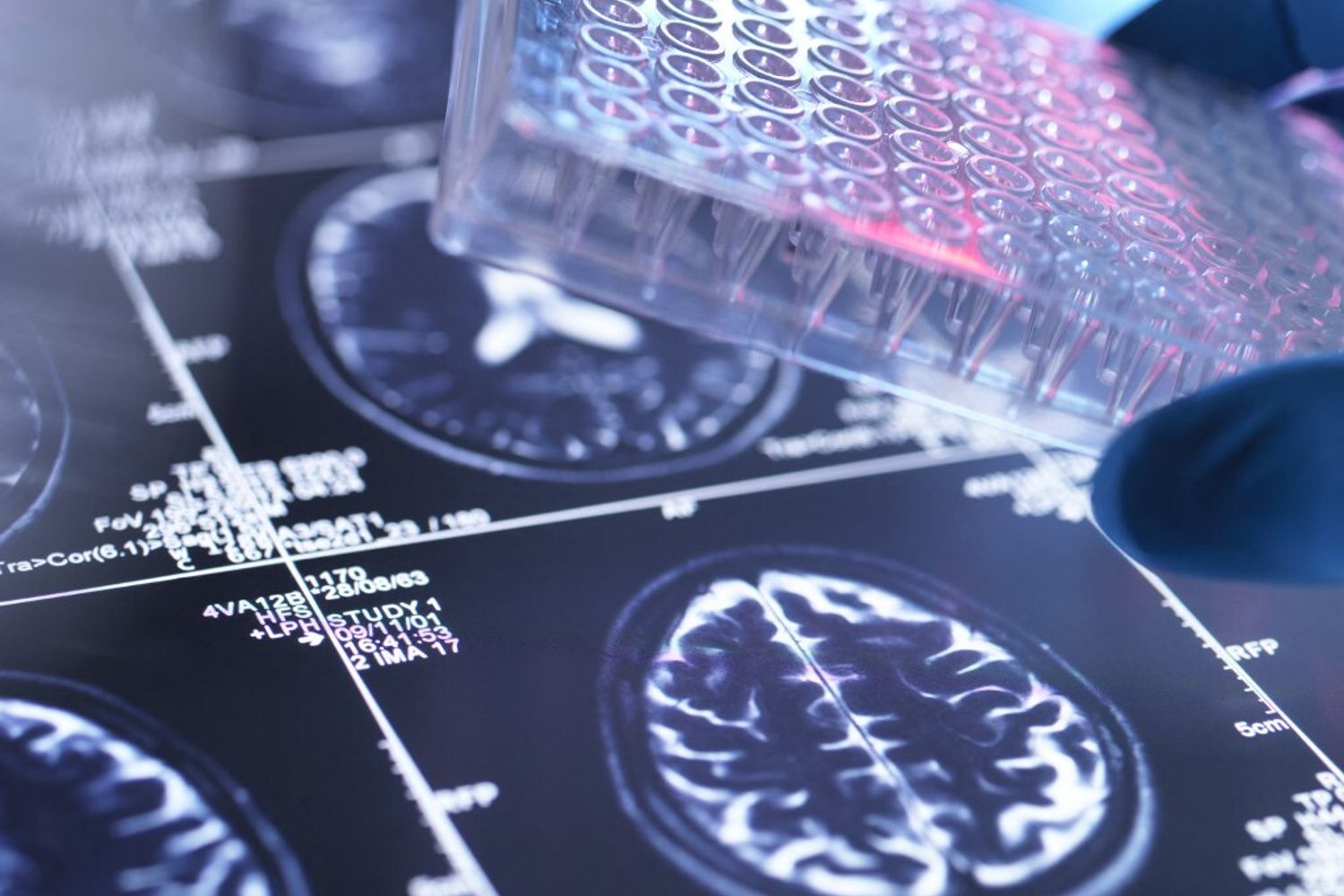 Malattie cerebro vascolari