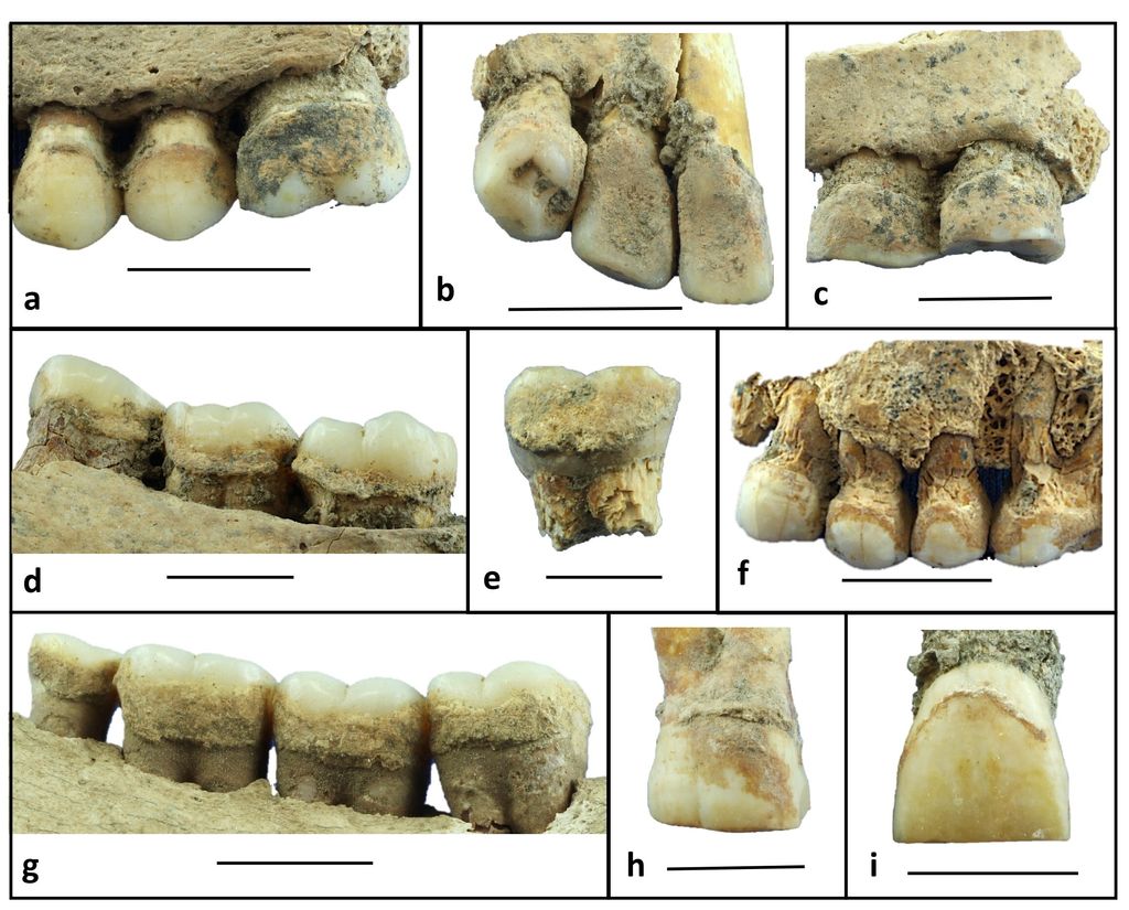 Il tartaro dentale di 6mila anni fa rivela la dieta neolitica