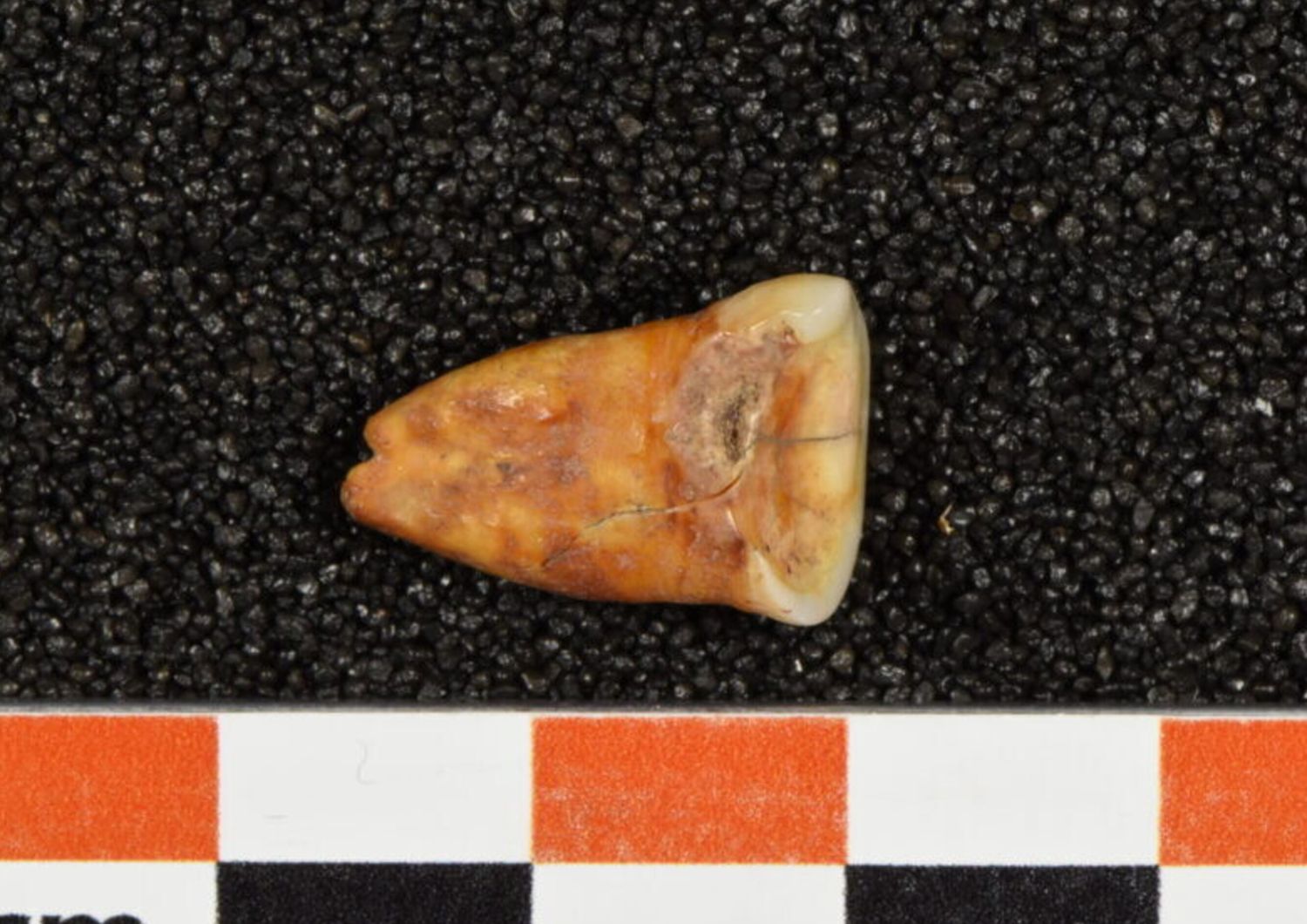 Dente umano proveniente dalla grotta Taforalt in Marocco, che mostra grave usura e carie