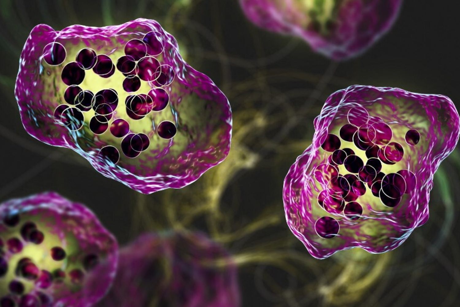 Illustrazione dell'infezione da virus del morbillo