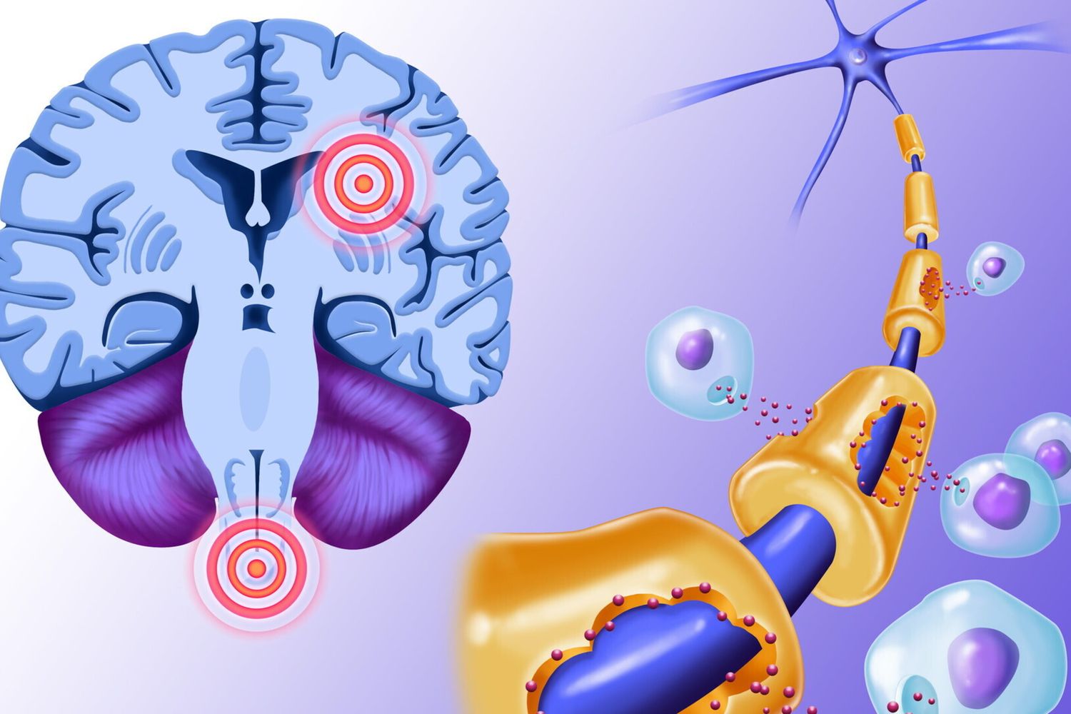 Sla,sclerosi laterale amiotrofica