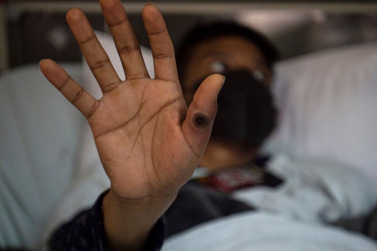 paziente colpito dal vaiolo delle scimmie