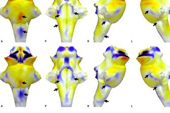 Il long Covid dipende dai danni al sistema di controllo del cervello