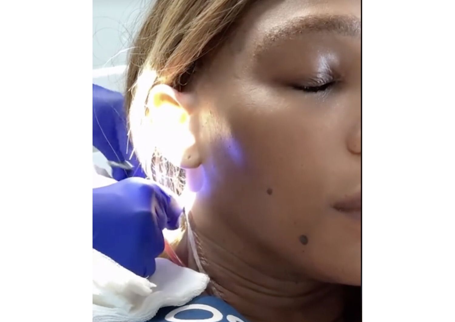 serena williams cisti operazione pompelmo tiktok