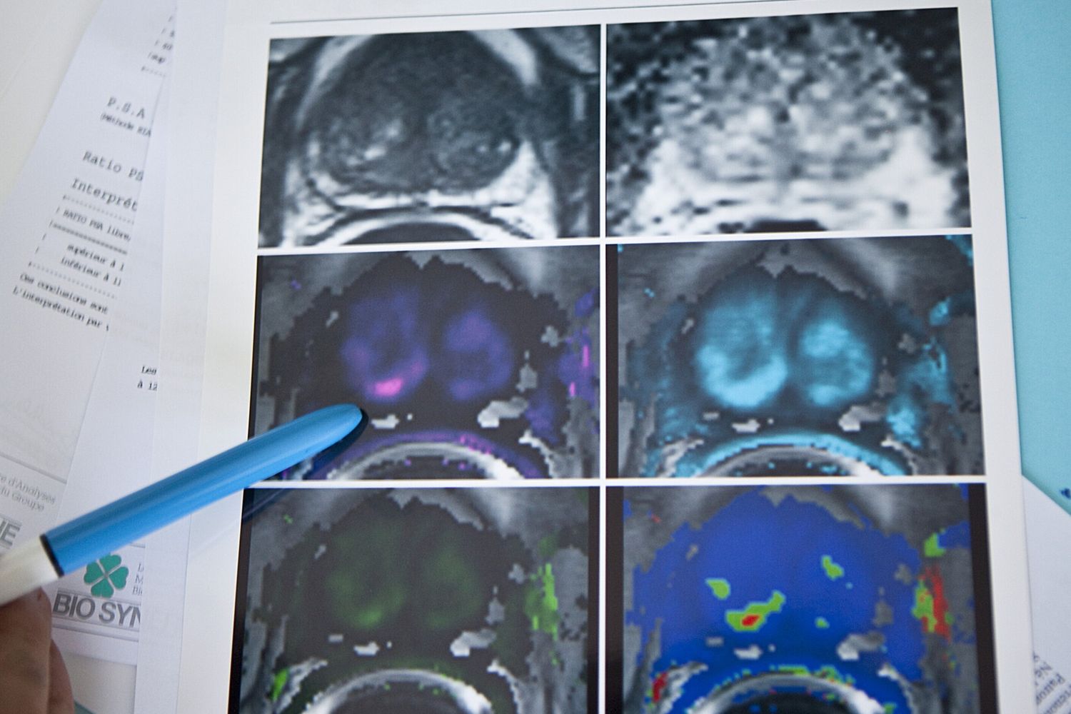 La vitamina K rallenta il cancro alla prostata nei topi