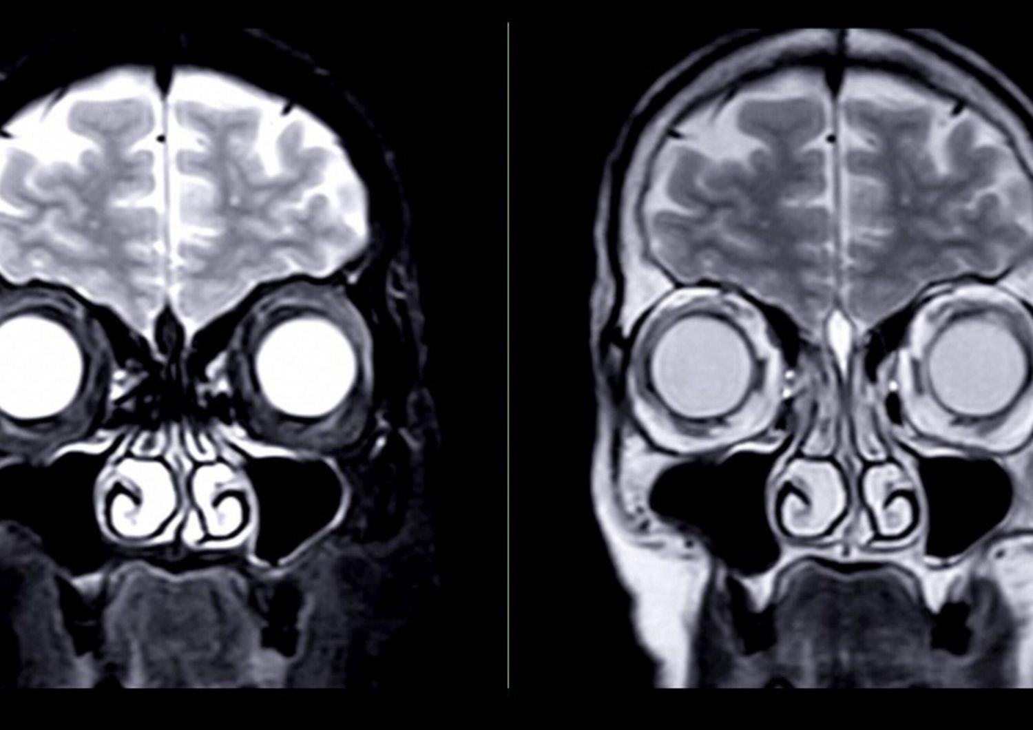 salute gli oppioidi modificano il volume cerebrale