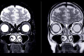 salute gli oppioidi modificano il volume cerebrale