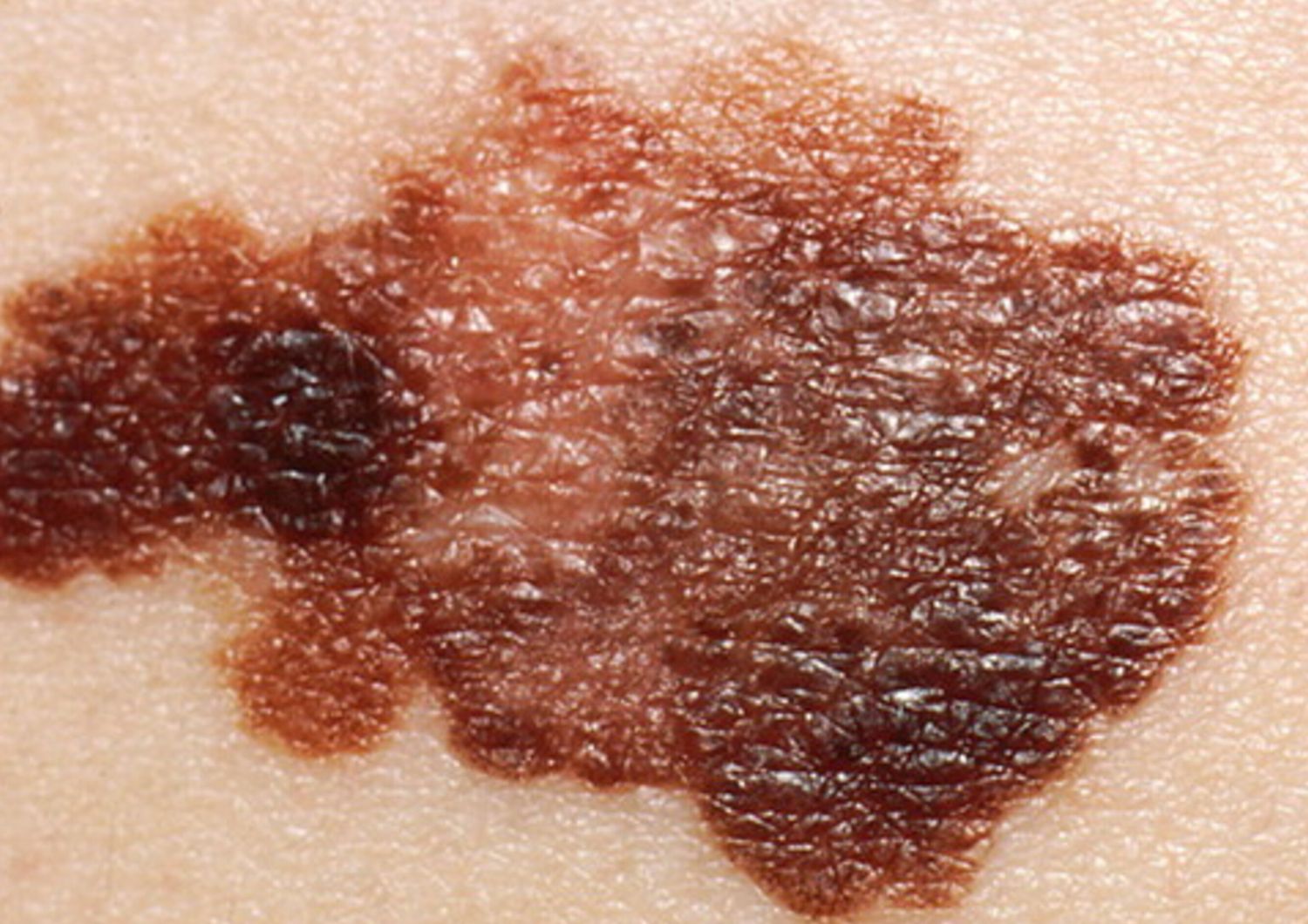 Il 2024 anno nero per il melanoma, i casi aumentati del 30%