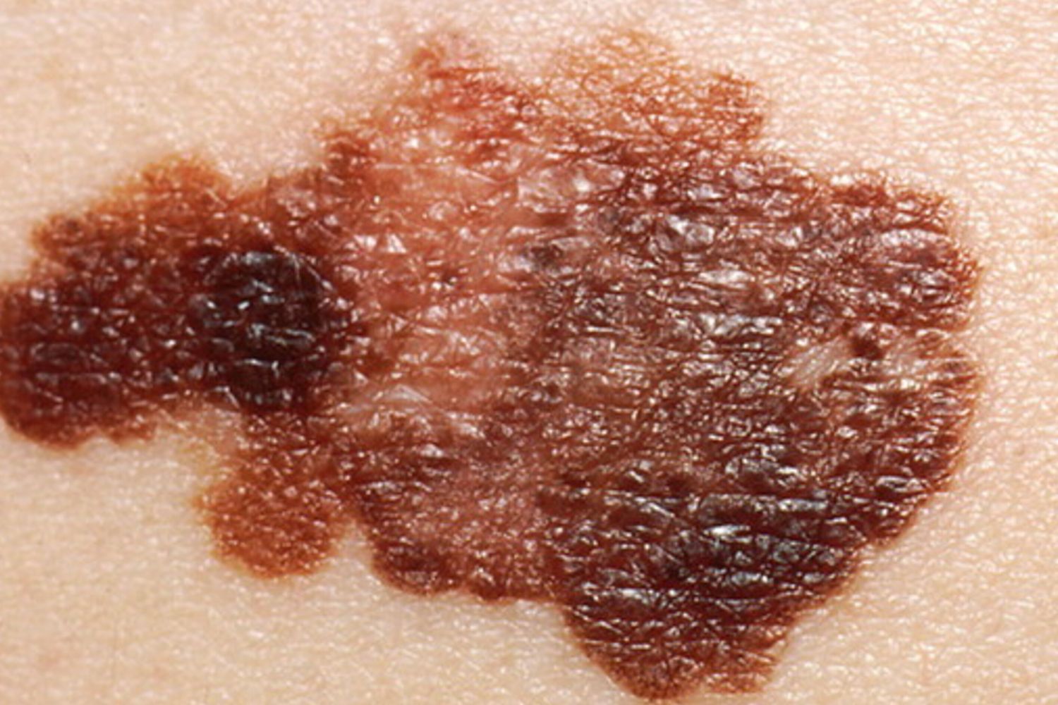 Il 2024 anno nero per il melanoma, i casi aumentati del 30%