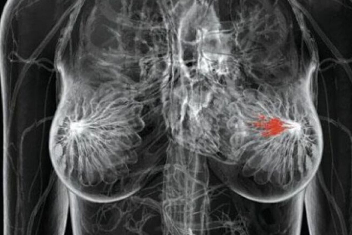 L'intelligenza artificiale migliora la rilevazione del cancro al seno