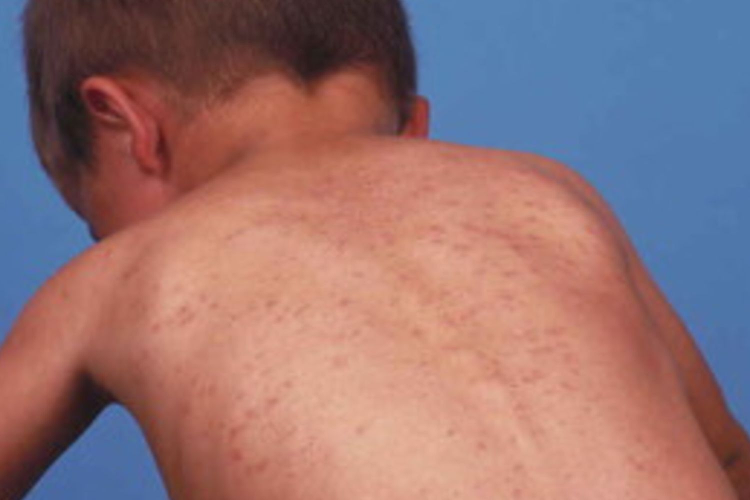 Nel 2024 in Italia più di mille casi di morbillo