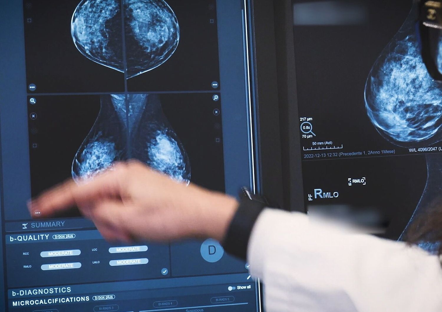 Tumori al seno, all'Humanitas diagnosi precoce grazie all'IA